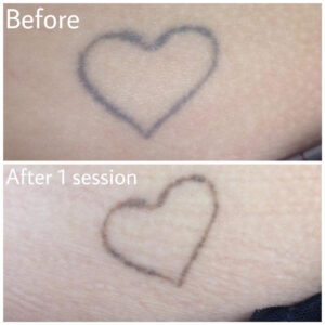 before-after2